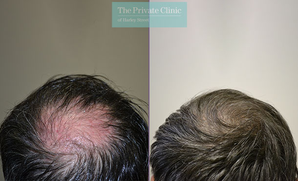 follicular unit transplantation hair transplant before after photo results dr luca de fazio 004LDF