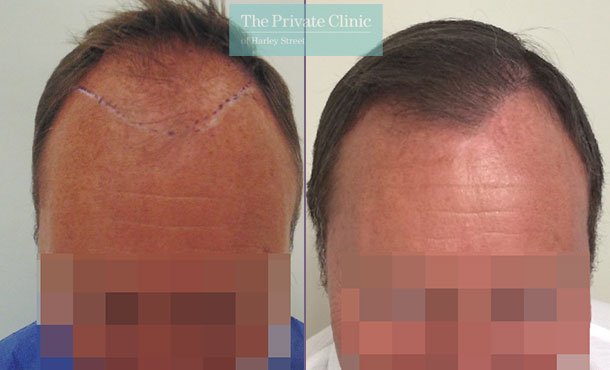 FUE Hair Transplant - 005MM-Front