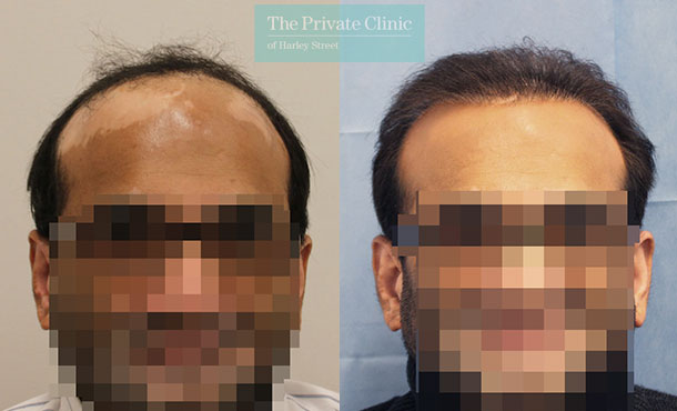 FUE Hair Transplant - 061RR