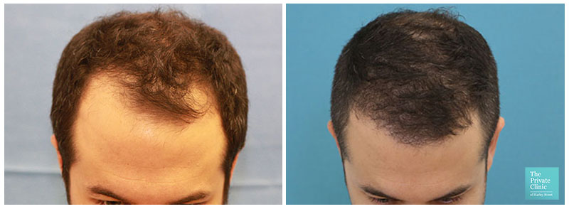 fue hair transplant before after hair restoration results birmingham hair loss clinic