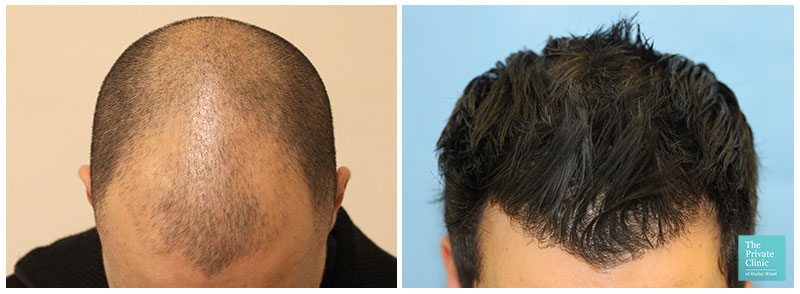 fue hair transplant before after hair restoration results hairline leeds hair loss clinic uk