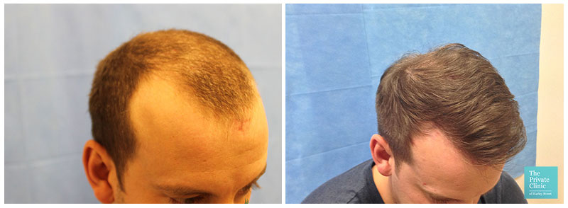 fue hair transplant before after hair restoration results temples hair loss clinic leeds uk