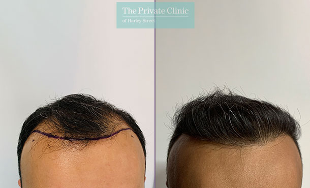 FUE Hair Transplant - 003FR