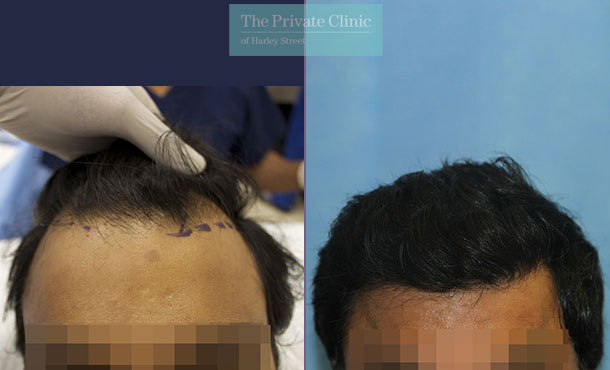 FUE Hair Ttransplant - 101RR-Front