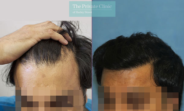 FUE Hair Transplant - 101RR-Side