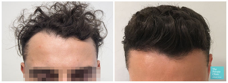 fue hair transplant before after results hair restoration clinic leeds uk