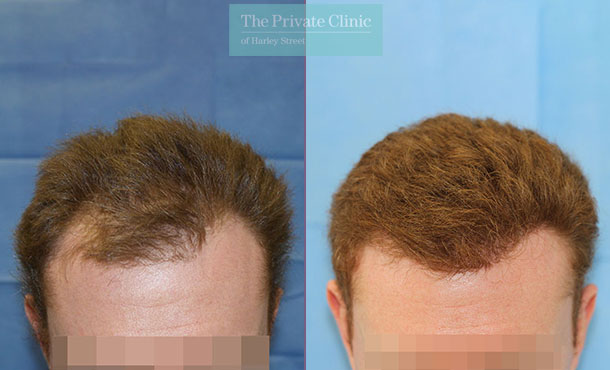 FUE Hair Transplant - 099RR