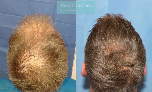 FUE Hair Transplant - 097RR-Crown