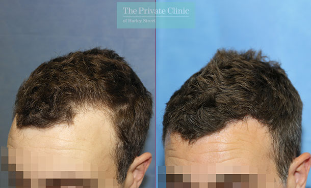 FUE Hair Transplant - 007RR-Side