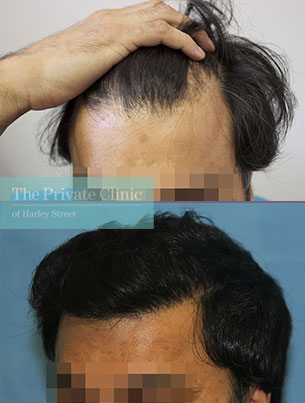 fue hair transplant grafts before after photos london results dr raghu reddy side 101RR fue hair transplant grafts before after photos london results dr raghu reddy side 101RR
