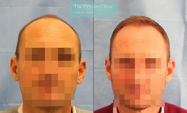 FUE Hair Transplant - 074RR-Front