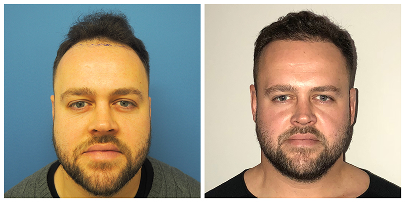 FUE Hair Transplant Clinic Manchester, Hair Restoration Surgery FUE Hair Transplant Clinic Manchester, Hair Restoration Surgery