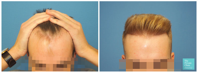 fue hair transplant hairline before after results uk birmingham hair loss clinic