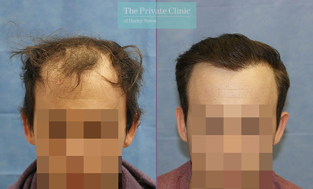 FUE Hair Transplant - 090RR