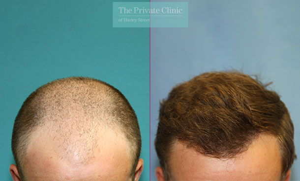 FUE Hair Transplant - 127RR