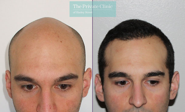 FUE Hair Transplant - 002RR