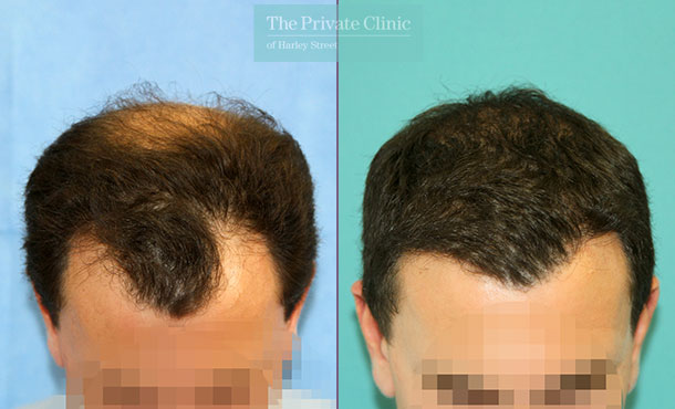 FUE Hair Transplant - 121RR