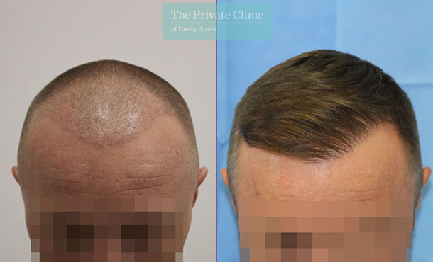 FUE Hair Transplant - 059RR