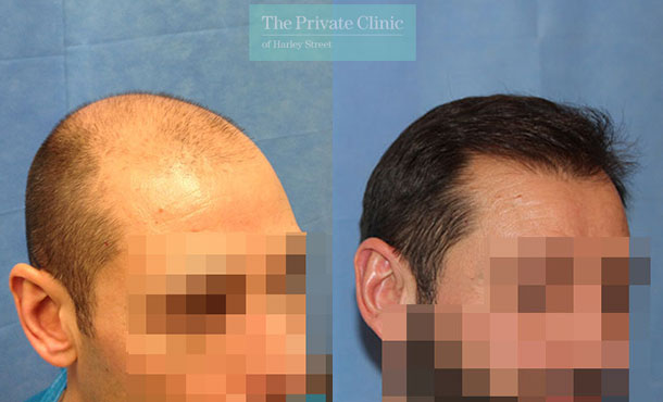 FUE Hair Transplant - 019RR-Side