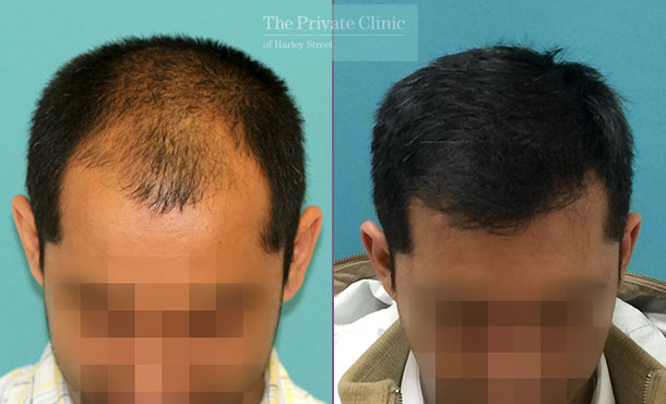 FUE Hair Transplant - 128RR