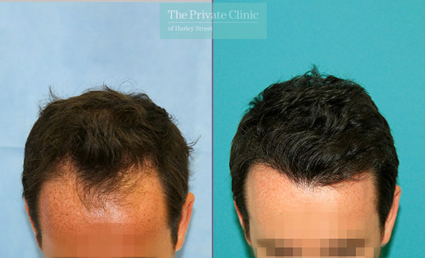 FUE Hair Transplant - 125RR