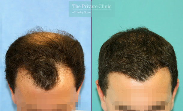 FUE Hair Transplant - 064RR