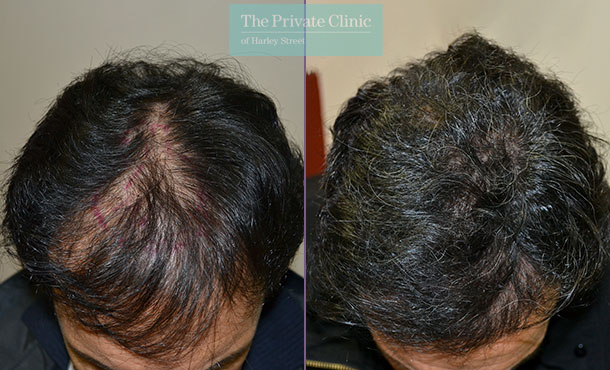 FUE Hair Transplant - 007LDF