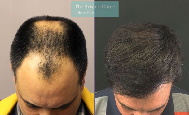 FUE Hair Transplant - 49RR