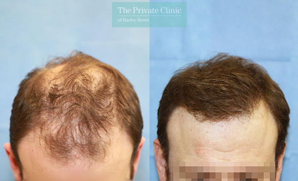 FUE Hair Transplant - 119RR