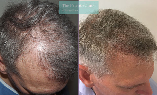 fue hair transplant procedure before after photos results mr michael mouzakis side 017MM