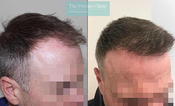 fue hair transplant procedure before after photos uk mr michael mouzakis side 013MM