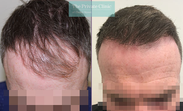 fue hair transplant procedure before after results mr michael mouzakis front 013MM