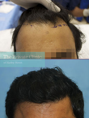 fue hair transplant procedure harley street london before after photos dr raghu reddy front 101RR fue hair transplant procedure harley street london before after photos dr raghu reddy front 101RR