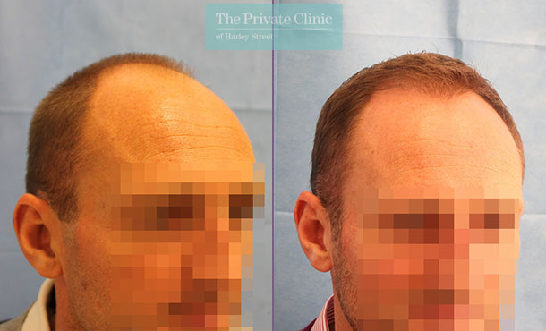 FUE Hair Transplant - 074RR-Side