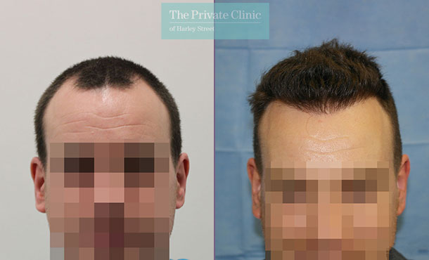 FUE Hair Transplant - 083RR