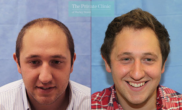 FUE Hair Transplant - 105RR