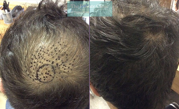 fue hair transplant recovery before after photo results dr luca de fazio 003LDF