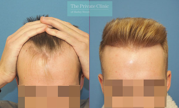 fue hair transplant recovery before after photo results mr michael mouzakis front
