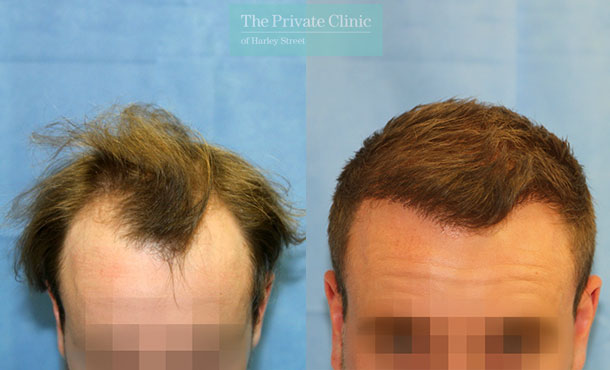 FUE Hair Transplant - 063RR