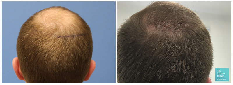 fue hair transplant restoration crown before after results uk birmingham hair loss clinic