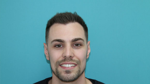 fue hair transplant restoration hair loss patient story review steve mobile
