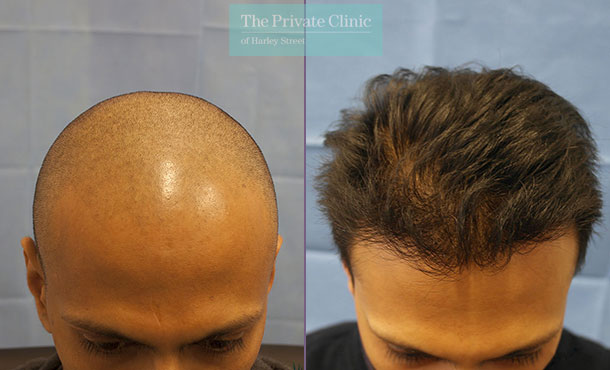 FUE Hair Transplant - 082RR