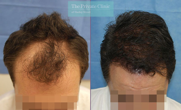 FUE Hair Transplant - 096RR-Front