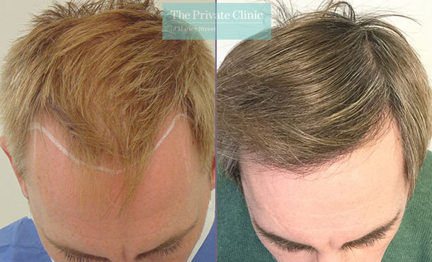 FUE Hair Transplant - 011MM