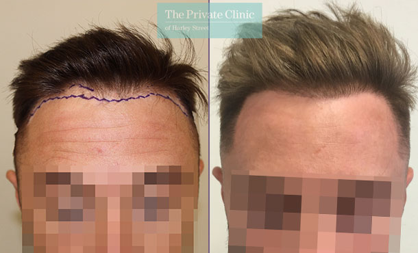 fue hair transplantation before after photo results mr michael mouzakis front 010MM