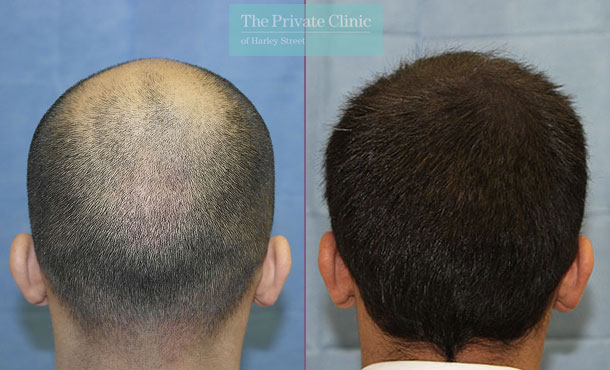 FUE Hair Transplant - 111RR-Back