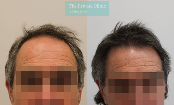 FUE Hair Transplant - 092RR