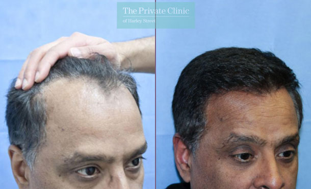 FUE Hair Transplant - 112RR