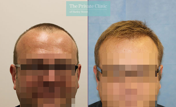 FUE Hair Transplant - 087RR