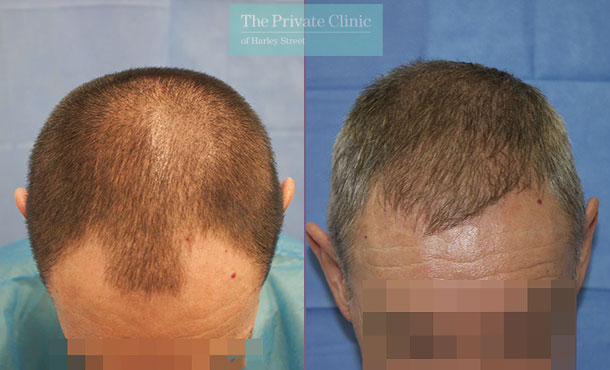 FUE Hair Transplant - 091RR